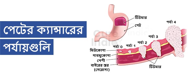 পেটের ক্যান্সারের পর্যায়গুলি